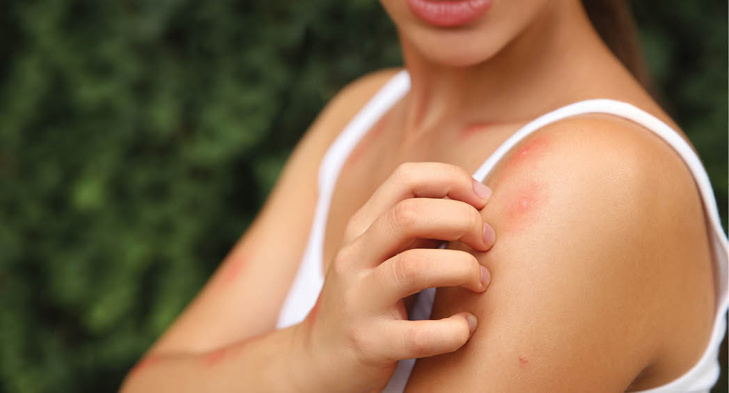 Woman scratching shoulder with insect bite outdoors, closeup
